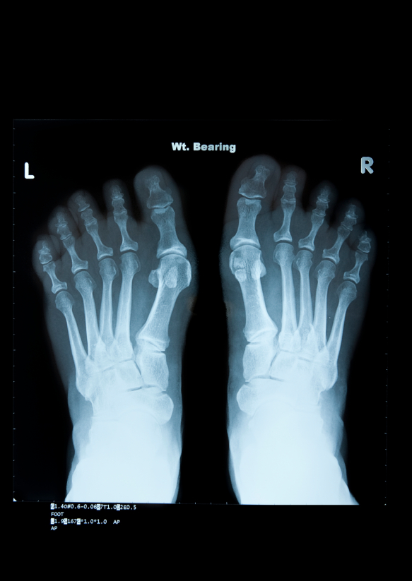 Bunions: Foot X-ray