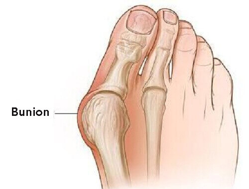 home cures for bunions